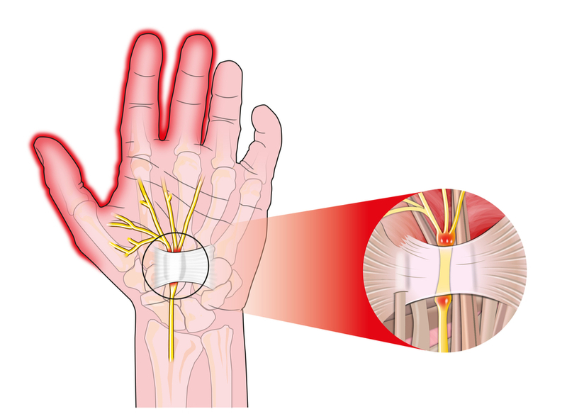 Carpal Tunnel Surgery