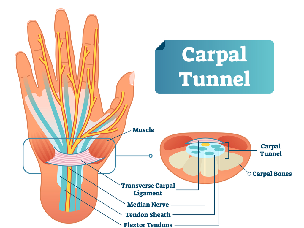 Carpal Tunnel Surgery