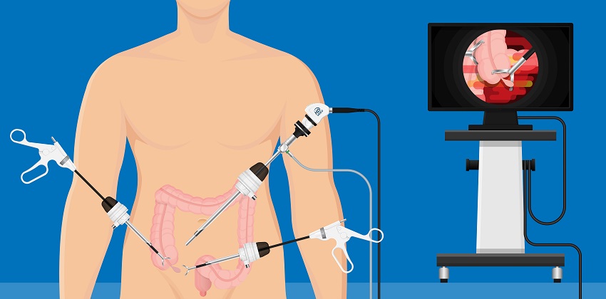 Colon Surgery