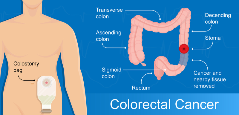 Colostomy