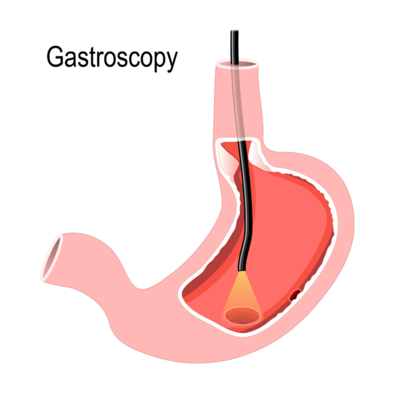 Gastroscopy