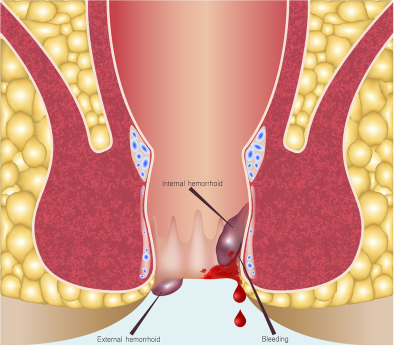 Haemorrhoid Surgery