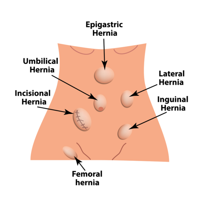 Hernia Surgery