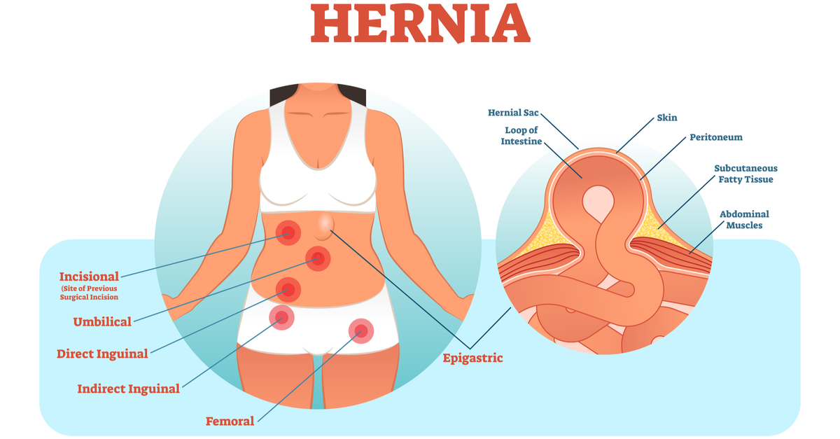Hernia Surgery