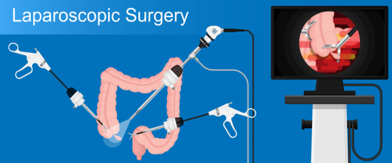 Laparoscopic Surgery